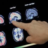 La maladie d'Alzheimer est la forme la plus courante de démence sénile (archives). KEYSTONE/AP/MATT YORK